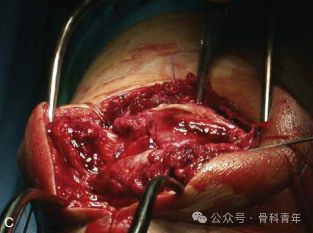 手术“金标准”：“克氏针张力带”内固定治疗髌骨骨折