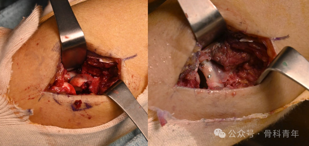 【手术技术】可吸收螺钉/克氏针内固定治疗桡骨头骨折