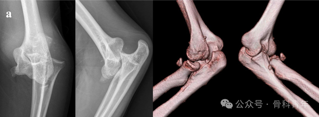 【手术技术】可吸收螺钉/克氏针内固定治疗桡骨头骨折