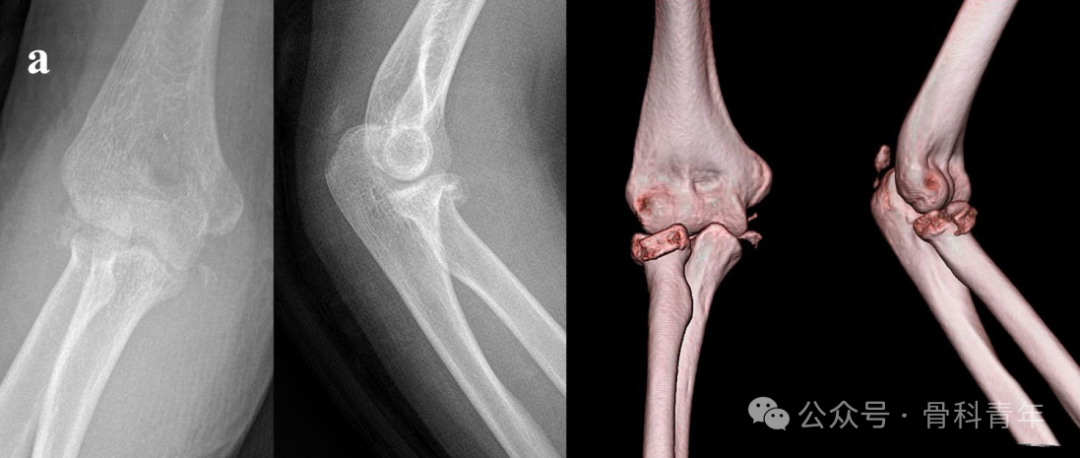 【手术技术】可吸收螺钉/克氏针内固定治疗桡骨头骨折