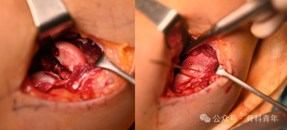 【手术技术】可吸收螺钉/克氏针内固定治疗桡骨头骨折