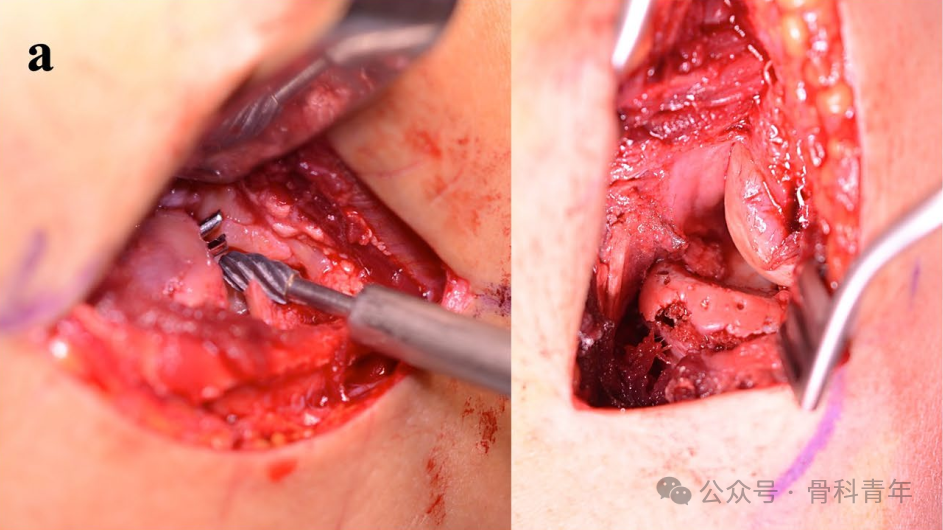 【手术技术】可吸收螺钉/克氏针内固定治疗桡骨头骨折