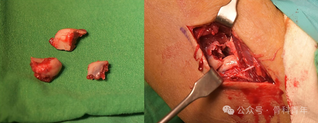 【手术技术】可吸收螺钉/克氏针内固定治疗桡骨头骨折