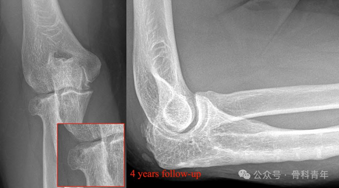 【手术技术】可吸收螺钉/克氏针内固定治疗桡骨头骨折