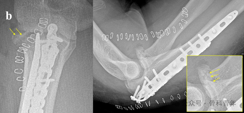 【手术技术】可吸收螺钉/克氏针内固定治疗桡骨头骨折