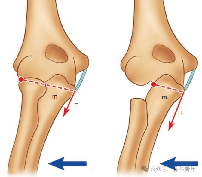 【手术技术】可吸收螺钉/克氏针内固定治疗桡骨头骨折