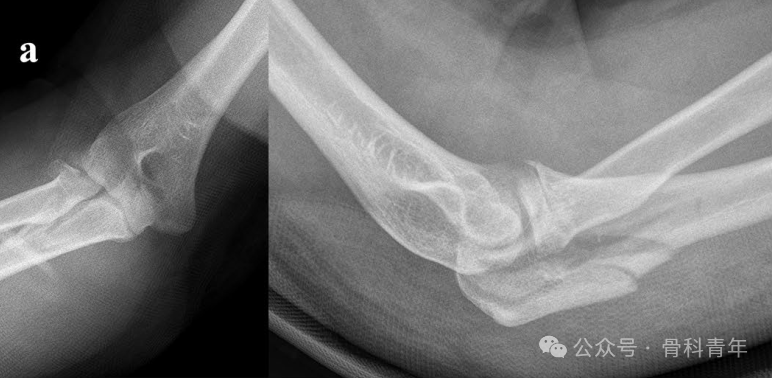【手术技术】可吸收螺钉/克氏针内固定治疗桡骨头骨折