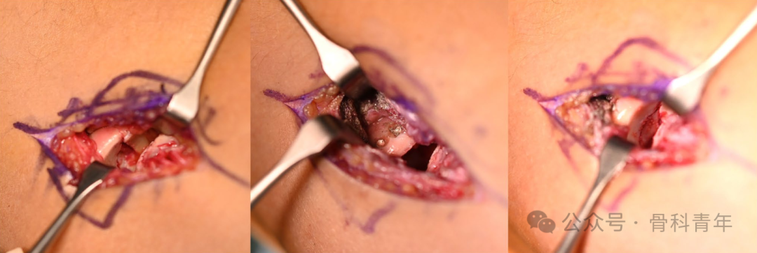 【手术技术】可吸收螺钉/克氏针内固定治疗桡骨头骨折