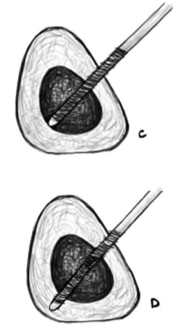 “无透视”的下肢外固定架技术：极端条件下的操作方法