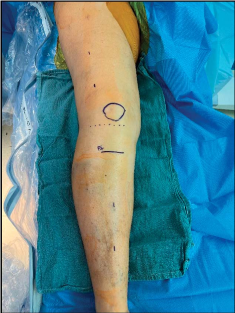 “无透视”的下肢外固定架技术：极端条件下的操作方法