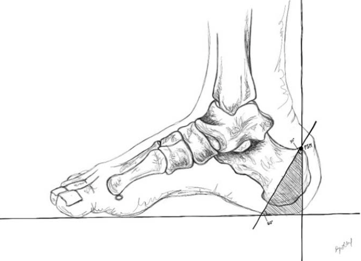 “无透视”的下肢外固定架技术：极端条件下的操作方法