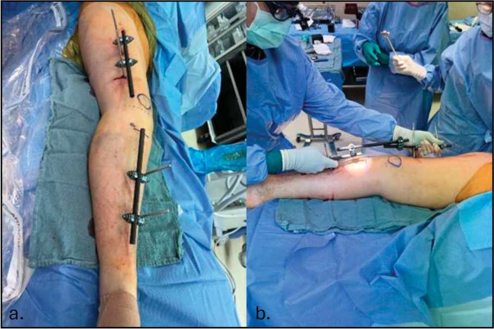 “无透视”的下肢外固定架技术：极端条件下的操作方法