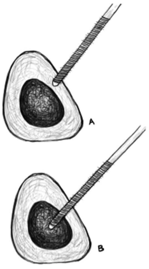 “无透视”的下肢外固定架技术：极端条件下的操作方法