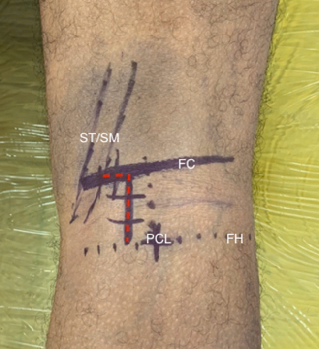 微创“Badet入路”复位固定胫骨后叉止点骨折