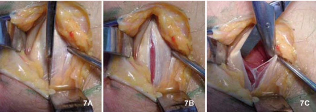 微创“Badet入路”复位固定胫骨后叉止点骨折