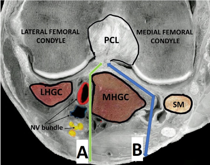 微创“Badet入路”复位固定胫骨后叉止点骨折