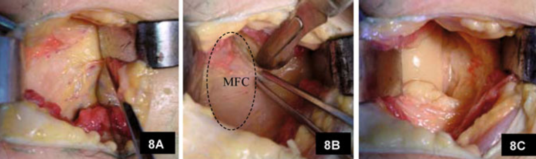 微创“Badet入路”复位固定胫骨后叉止点骨折