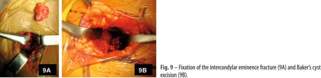 微创“Badet入路”复位固定胫骨后叉止点骨折