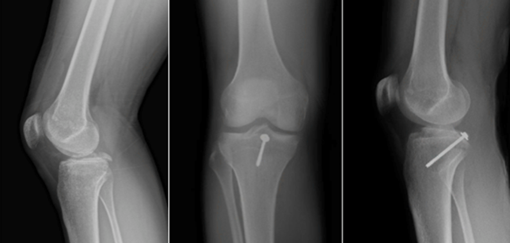 微创“Badet入路”复位固定胫骨后叉止点骨折