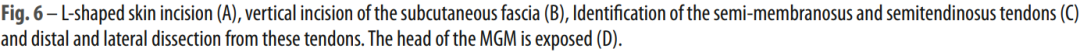微创“Badet入路”复位固定胫骨后叉止点骨折