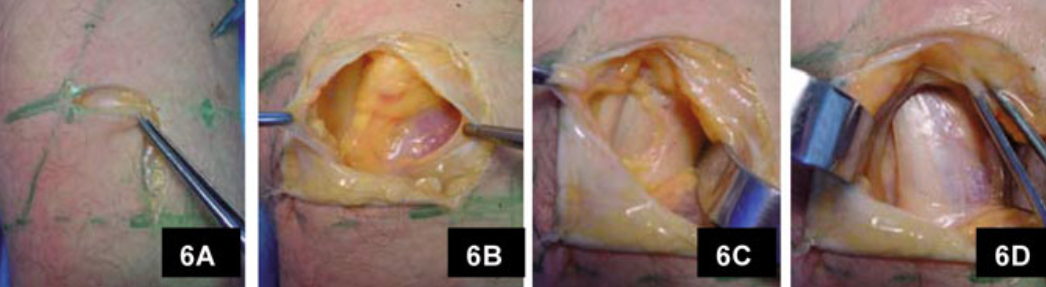 微创“Badet入路”复位固定胫骨后叉止点骨折