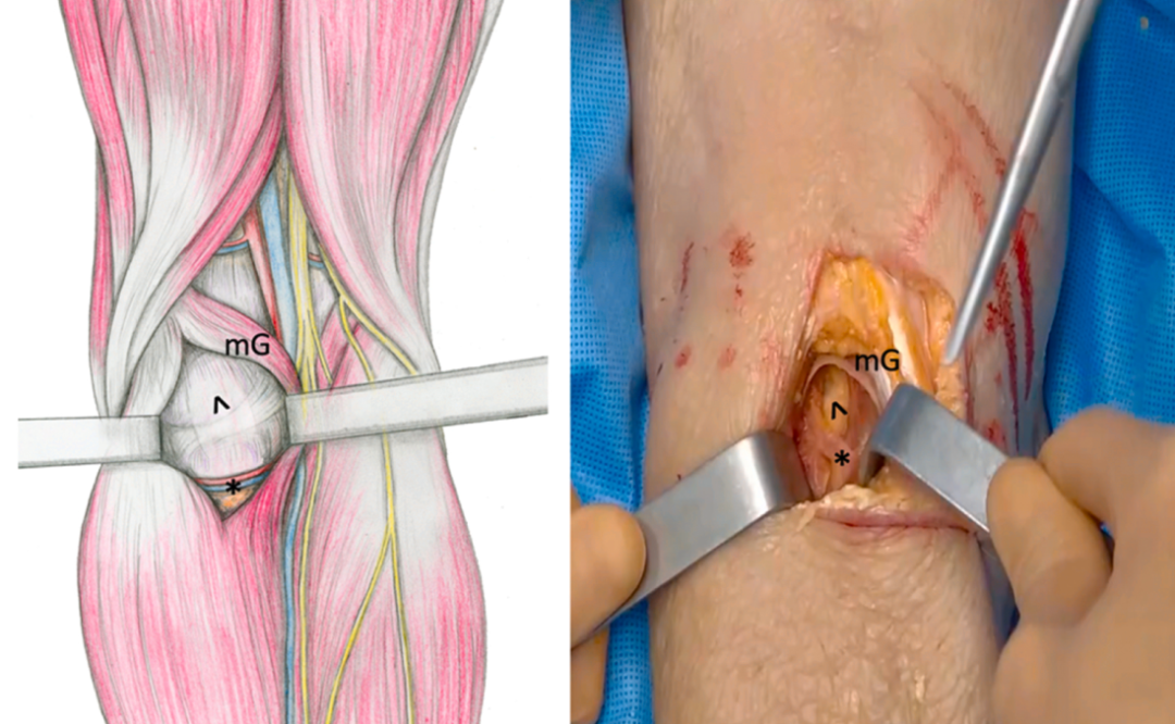 微创“Badet入路”复位固定胫骨后叉止点骨折