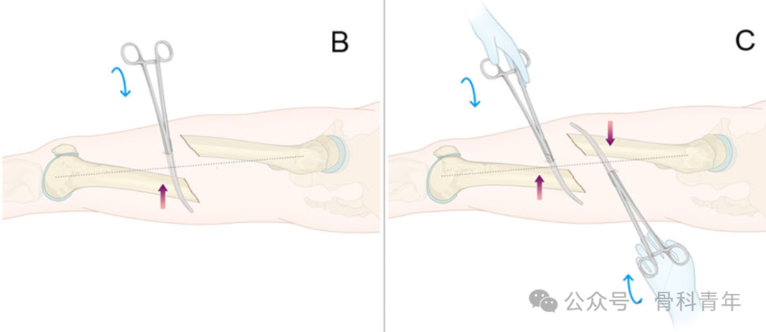 手术技巧｜“血管钳撬拨技术”辅助复位粗隆下骨折