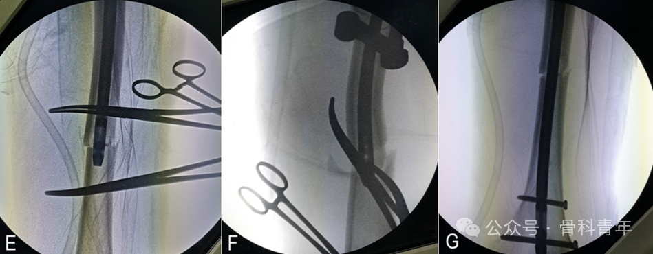 手术技巧｜“血管钳撬拨技术”辅助复位粗隆下骨折