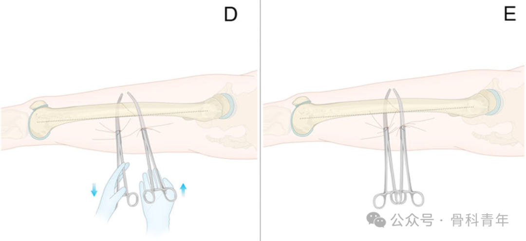 手术技巧｜“血管钳撬拨技术”辅助复位粗隆下骨折