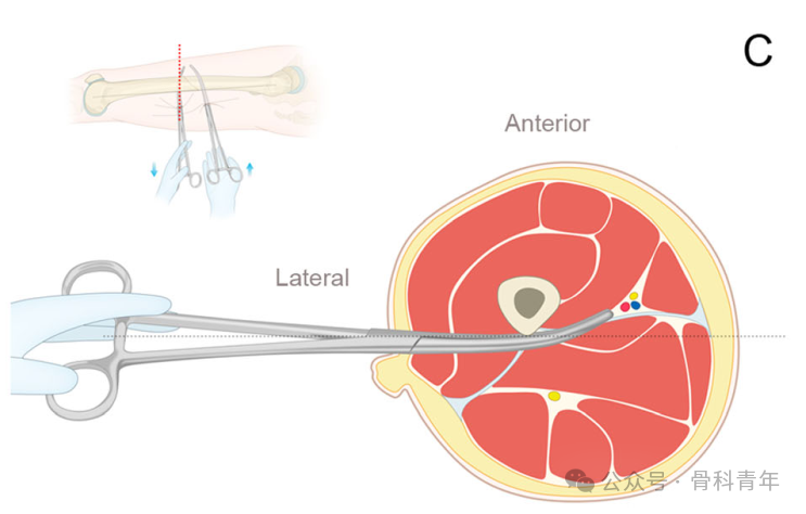 手术技巧｜“血管钳撬拨技术”辅助复位粗隆下骨折