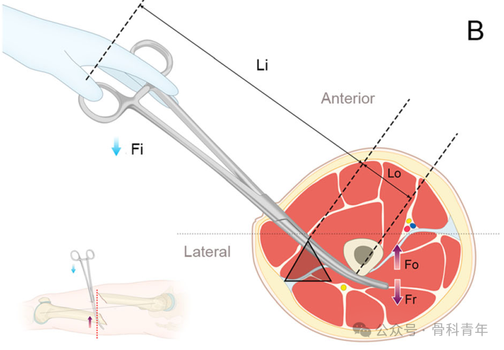 手术技巧｜“血管钳撬拨技术”辅助复位粗隆下骨折