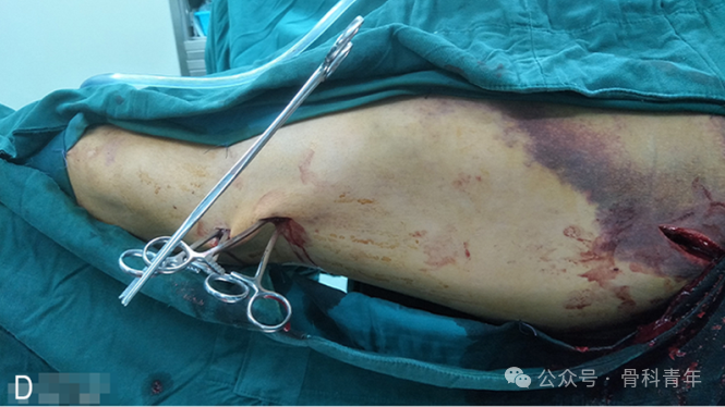 手术技巧｜“血管钳撬拨技术”辅助复位粗隆下骨折