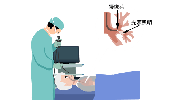 做完支气管镜怎么保养“一觉醒来就做完了...”支气管镜检查还可以这样？！_https://www.jmylbn.com_新闻资讯_第8张