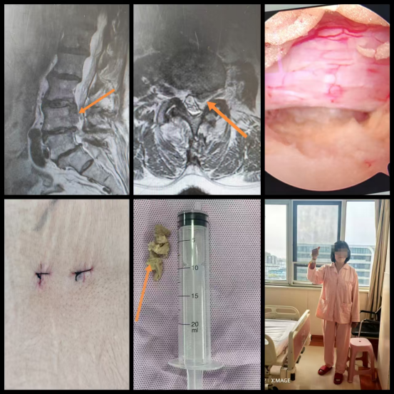 开刀孔怎么开刀怕开刀？椎间盘突出或椎管狭窄有救了！两个“钥匙孔”，让您术后轻松走起来。_https://www.jmylbn.com_新闻资讯_第4张