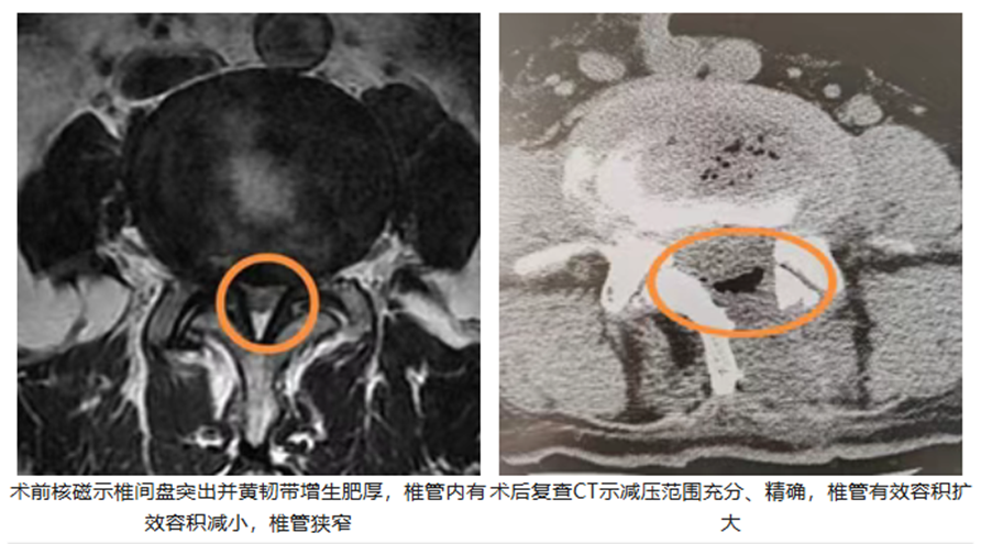 开刀孔怎么开刀怕开刀？椎间盘突出或椎管狭窄有救了！两个“钥匙孔”，让您术后轻松走起来。_https://www.jmylbn.com_新闻资讯_第6张