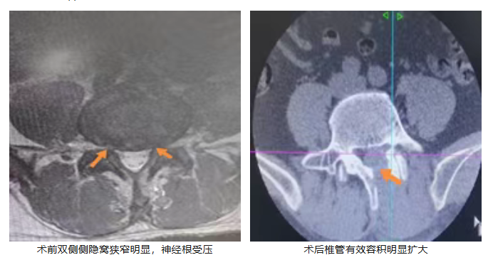 开刀孔怎么开刀怕开刀？椎间盘突出或椎管狭窄有救了！两个“钥匙孔”，让您术后轻松走起来。_https://www.jmylbn.com_新闻资讯_第5张