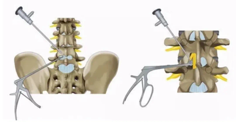 开刀孔怎么开刀怕开刀？椎间盘突出或椎管狭窄有救了！两个“钥匙孔”，让您术后轻松走起来。_https://www.jmylbn.com_新闻资讯_第3张