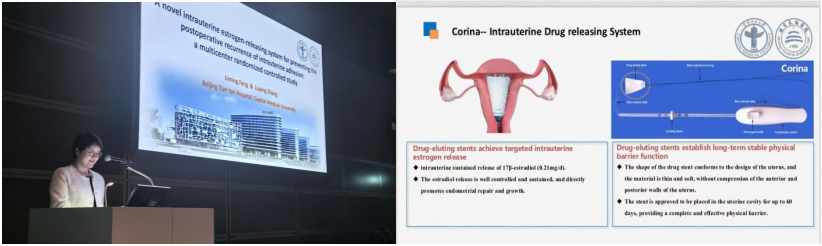 子宫支架怎么上中国声音 ｜ 冯力民教授：“重塑内膜功能，保护生育力”  雌激素缓释子宫药物支架新技术领跑宫内疾病治疗新时代！_https://www.jmylbn.com_新闻资讯_第6张