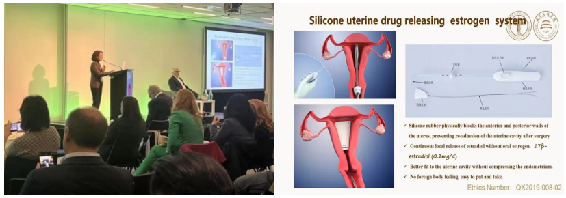 子宫支架怎么上中国声音 ｜ 冯力民教授：“重塑内膜功能，保护生育力”  雌激素缓释子宫药物支架新技术领跑宫内疾病治疗新时代！_https://www.jmylbn.com_新闻资讯_第4张