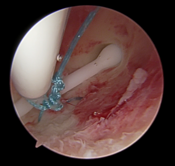 prolene缝线 打结时为什么要喷水曼月乐环总掉？缝合固定术的“10个关键技巧”全公开！从缝线选针到打结，手把手教学_https://www.jmylbn.com_新闻资讯_第9张