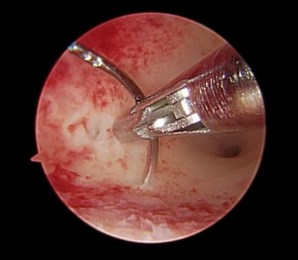 prolene缝线 打结时为什么要喷水曼月乐环总掉？缝合固定术的“10个关键技巧”全公开！从缝线选针到打结，手把手教学_https://www.jmylbn.com_新闻资讯_第7张