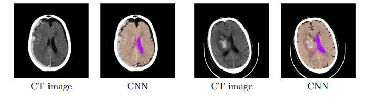 文献速递：人工智能医学影像分割--- MR-CT多图谱配准，由完全自动化的基于CNNs的大脑结构分割引导 - 影像组学科研世界 | 国内第一个 ...