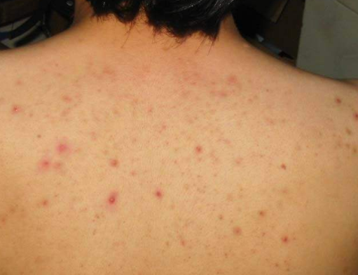 【科普】毛囊炎不同部位表现症状不同，进来看看！