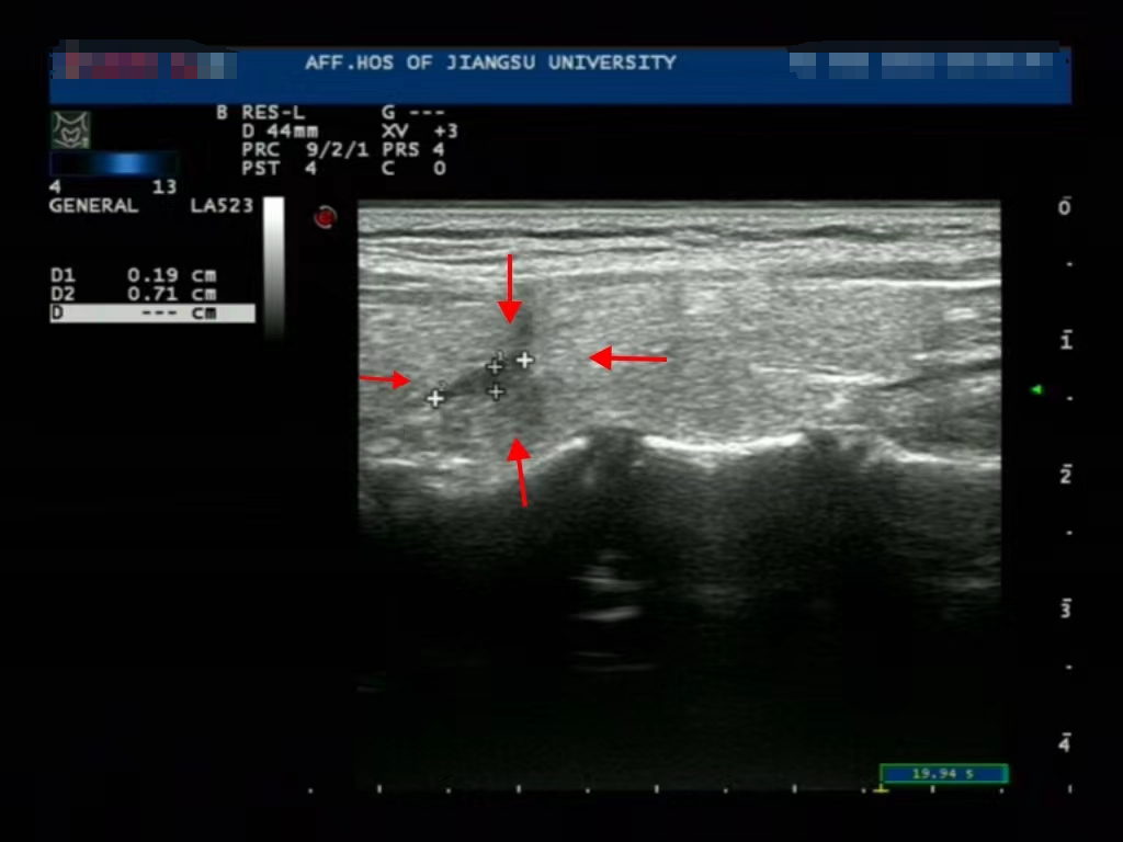 微波针是什么以“针”代“刀”，带你了解甲状腺结节微波消融术_https://www.jmylbn.com_新闻资讯_第11张