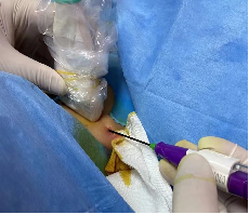 微波针是什么以“针”代“刀”，带你了解甲状腺结节微波消融术_https://www.jmylbn.com_新闻资讯_第6张