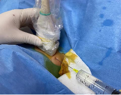 微波针是什么以“针”代“刀”，带你了解甲状腺结节微波消融术_https://www.jmylbn.com_新闻资讯_第5张