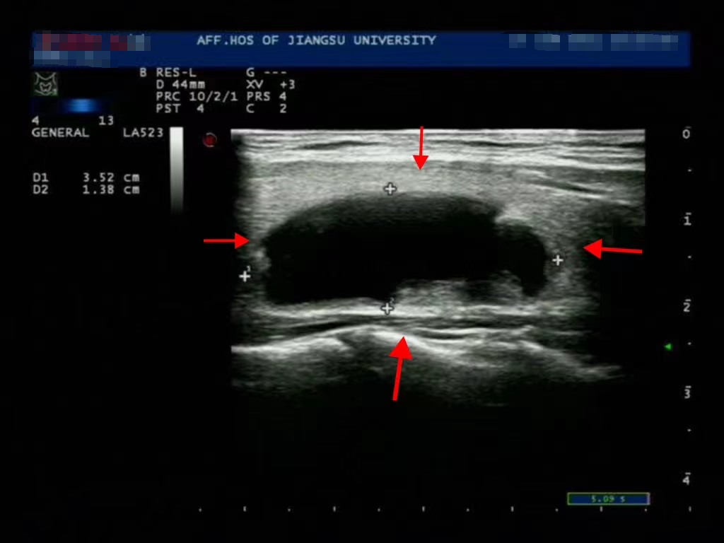 微波针是什么以“针”代“刀”，带你了解甲状腺结节微波消融术_https://www.jmylbn.com_新闻资讯_第10张