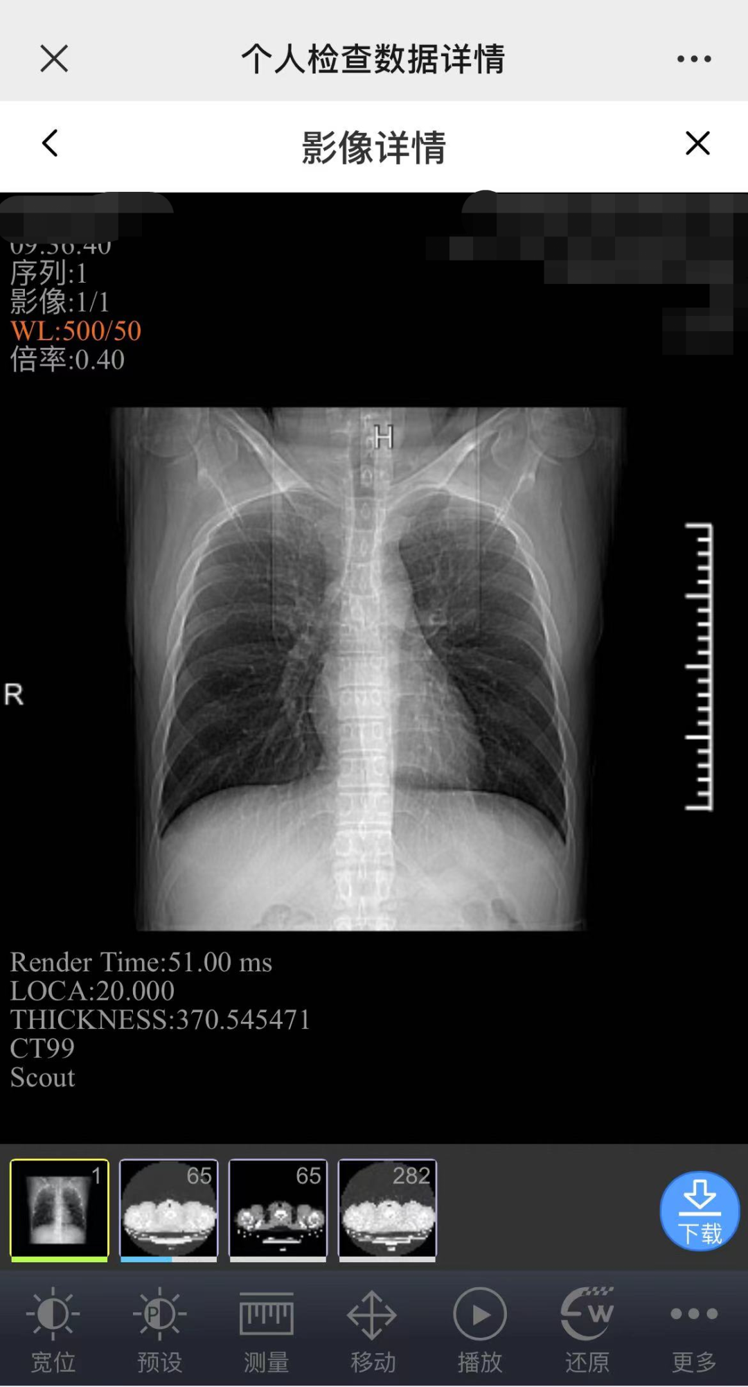 医用ct胶片怎么收纳告别“胶片时代”，CT片手机可以轻松查_https://www.jmylbn.com_新闻资讯_第15张