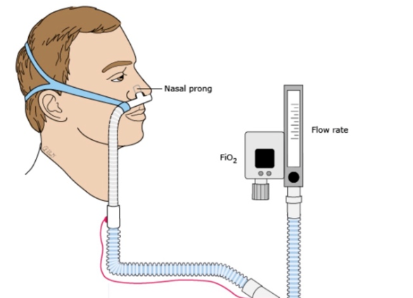 什么是有创呼吸机图片儿童ICU里的“呼吸外挂”哪家更强：经鼻高流量氧疗 vs 有创机械通气_https://www.jmylbn.com_新闻资讯_第3张