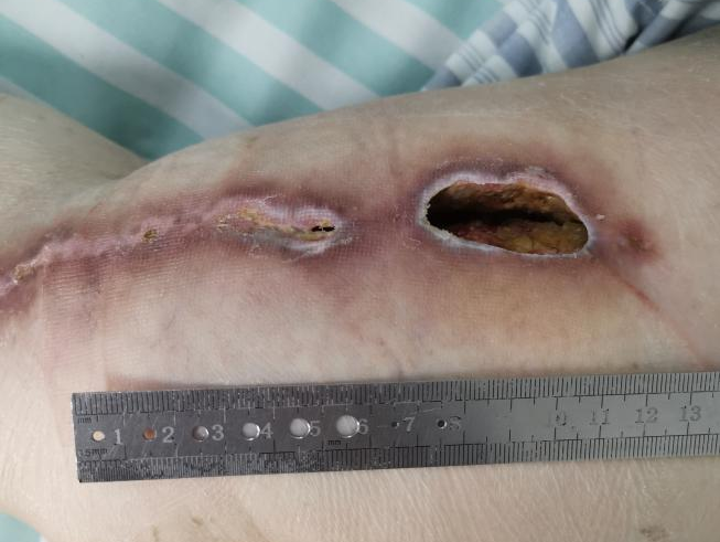 怎么促进vsd伤口愈合负压封闭引流术（VSD）：让伤口愈合更轻松_https://www.jmylbn.com_新闻资讯_第6张